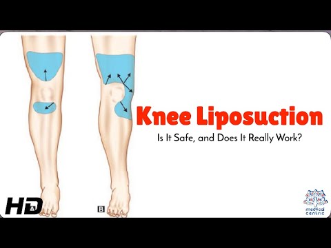 Knee Liposuction: The Truth About Safety and Results! 🦵✨