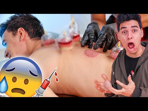 اول مرة اعمل حجامة في حياتي 😱💉