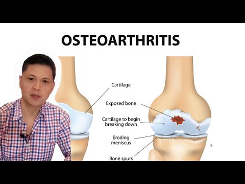 Anu ba ang Osteoarthritis? Mga dapat gawin para mawala ang sakit at sintomas ng Arthritis.