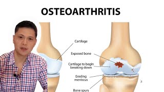 Anu ba ang Osteoarthritis? Mga dapat gawin para mawala ang sakit at sintomas ng Arthritis.
