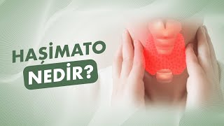 Haşimato Nedir? Haşimato Belirtileri Nelerdir?
