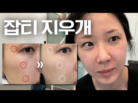 현존 최강이라는 색소시술 받고왔습니다(솔직후기)