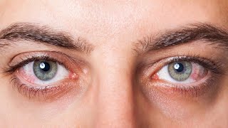 Remedies for DRY EYES That Actually Work !!