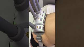 FAT LOSS Without Diet & Exercise! Achieve that with SculpSure! #diet  #shorts