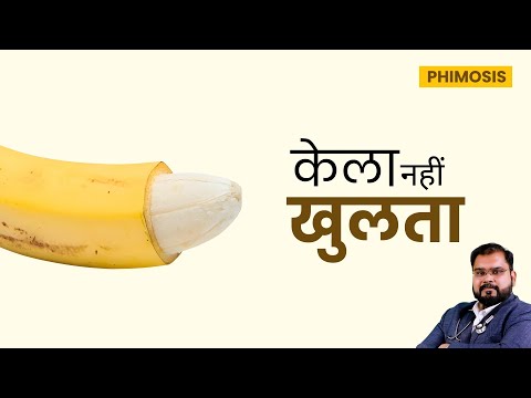 Original ZSR Circumcision in New Delhi | 3 Patients Live Results