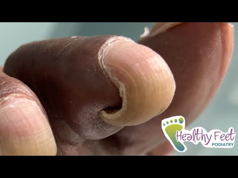DEEP DIGGING  TOE NAIL
