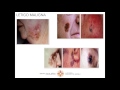 Melanoma Awareness and Detection