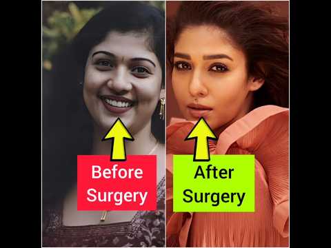 ഞെട്ടിപ്പോകും😱പ്ലാസ്റ്റിക് സർജറി ചെയ്ത് പണിപാളിയ മലയാള നടിമാർ🤥Plastic Surgery of Malayalam actre👃
