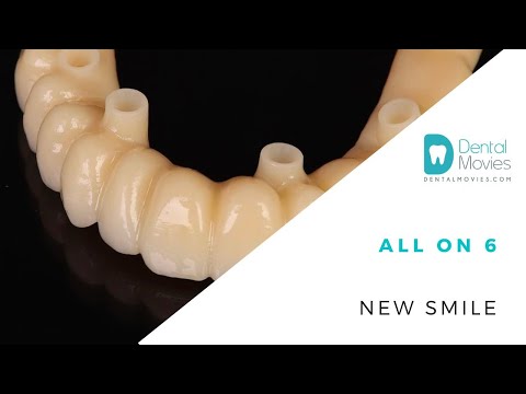 All on 6 - new smile