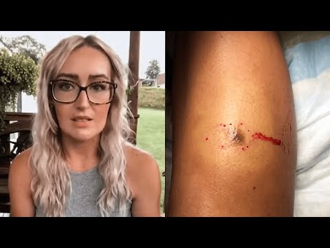 Mysterious Mark On Woman's Leg That Tells Drs She's Going To Die