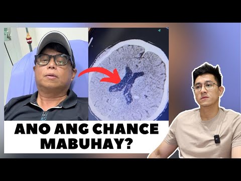 IGAN ARNOLD CLAVIO, MAY PAGDURUGO SA ULO. SAN NAKUHA AT PANO MAKAIWAS?