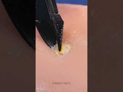 How Doctors Really Remove Calluses 👣