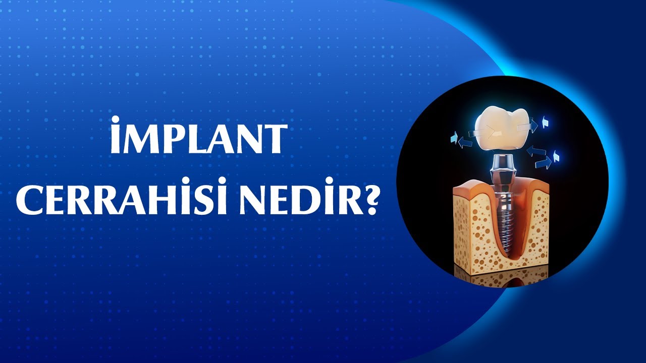 İmplant Tedavisinin Aşamaları: İlk Muayeneden Proteze