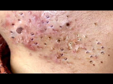 Big Cystic Acne Blackheads Extraction Blackheads & Milia, Whiteheads Removal Pimple Popping # 8403