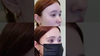 Upper Eyelid Lift - Upper Blepharoplasty Before & After