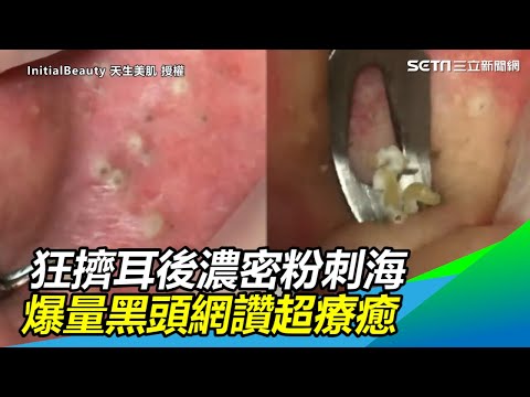 看不夠！狂擠耳後濃密粉刺海　爆量黑頭超療癒網求：出下集｜三立新聞網SETN.com