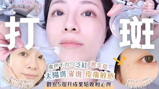 私分享打斑5個月後成果┃瑞士MVP生物療程抗敏效果超驚喜～♥┃單次收費小店及必買產品推介┃Katy Beauty