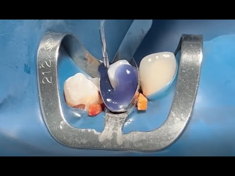 Close The Restoration-focused Dental Process