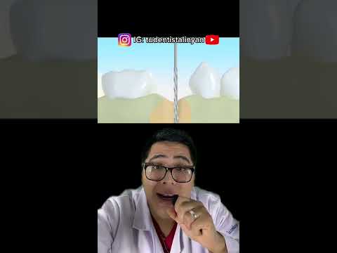 👉🏻 MIRA ANTES ESTE VIDEO SI TE VAN A SACAR UNA MUELA 👀
