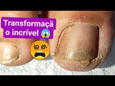 CLIENTE VEIO COM O PÉ NESSA SITUAÇÃO e Tive que fazer um milagre😵 Transformação incrível