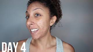 HOME REMEDY FOR ACNE