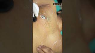 One-Sided Gynecomastia Dressing and RF Session