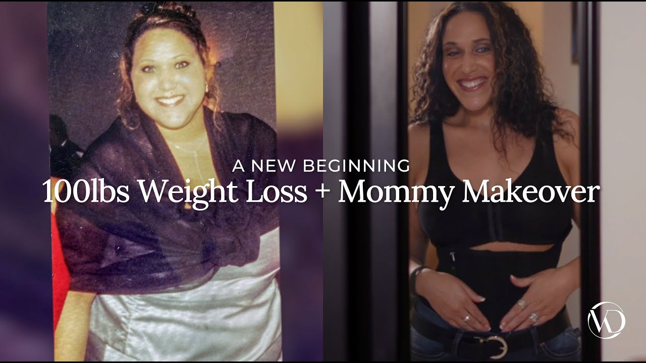 Weight loss transformation and mommy makeover journey.