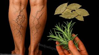 You’ll NEVER Believe What Erased My Varicose Veins! 🤯 2 Home Remedies 🌿🍀