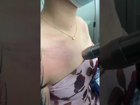 SCAR FREE TATTOO REMOVAL ep1730 #short