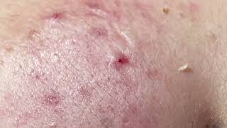 One of the acne problems: cosmetics - Acnes Treatments Mai Ngoc 💕💕💕