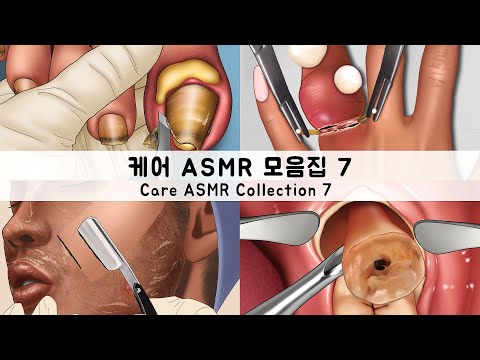 ASMR 케어 애니메이션 모음집7 내성발톱,머릿니,충치,사랑니 | CARE ANIMATION COLLECTION7 Ingrown toenails,head lice,cavities