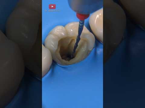 RCT dental treatment #dentist #shorts