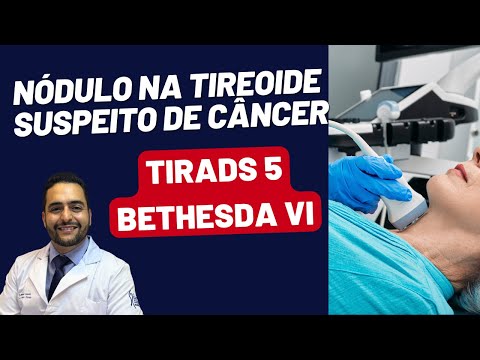 NÓDULO NA TIREOIDE = CÂNCER, COMO SABER? COMO TRATAR?