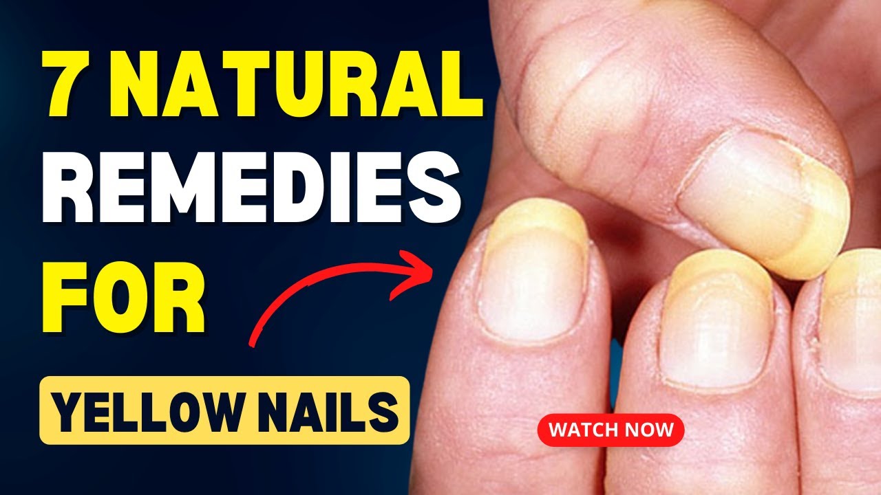 Say Goodbye To Yellow Nails With These 7 Natural Remedies