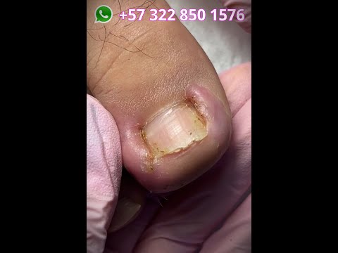 Mira cómo salvamos esta uña súper lastimada