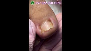 Mira cómo salvamos esta uña súper lastimada