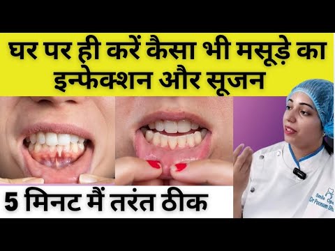 मसूड़े में सूजन ,दर्द और इन्फेक्शन का घरेलू इलाज | Home Remedies For Gum swelling, Pain and infection