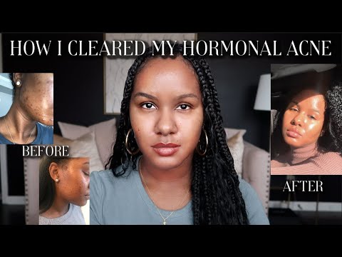 HOW I CLEARED MY HORMONAL ACNE | SKINCARE JOURNEY| NO ACCUNTANE