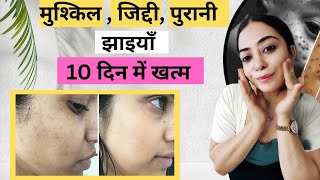 Pigmentation treatment at home | Jhaiya Khatam Karne Ka Tarika | Glowing Skin | Pooja Luthra