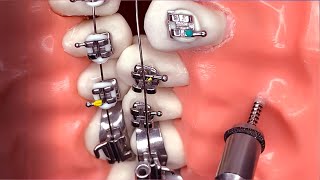 Remove The Rubber Bands And Metal Brackets From The Teeth