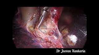 *Rare case* Laparoscopic Cholecystectomy in DUBIN JOHNSON syndrome(Black Liver)| Dr Jeevan Kankaria
