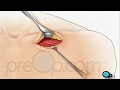 Pacemaker Surgery and Care