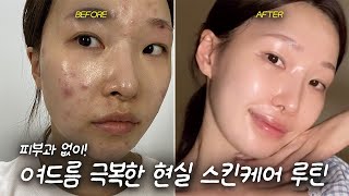 피부과 없이 여드름&염증피부 극복한 스킨케어방법 (Acne-free skincare routine)