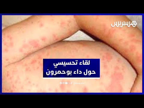 لقاء تواصلي للتحسيس بمخاطر "بوحمرون" وسبل الوقاية