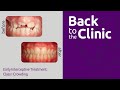 Orthodontic Treatment and Crowding Issues