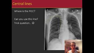 CXR Basics with a Radiologist: tubes & lines