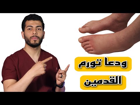 اسرع علاج لتورم القدمين فى المنزل وبدون أدوية|تورم القدمين الاسباب والعلاج |انتفاخ القدمين