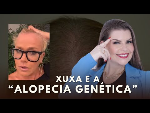 Alopecia genética: entenda a condição que afeta a Xuxa