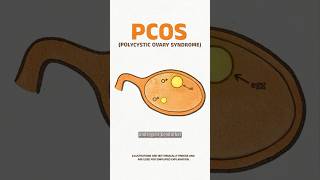 PCOD & PCOS