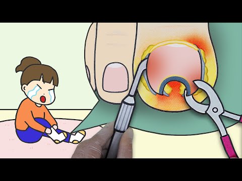 😵보기만해도 아픈 내성발톱 치료하기! :: 셀프어쿠스틱